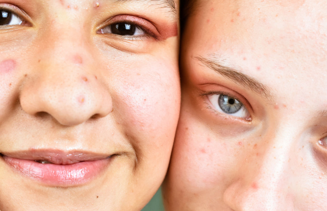 Teen vs Adult Acne? What is the difference?&nbsp;