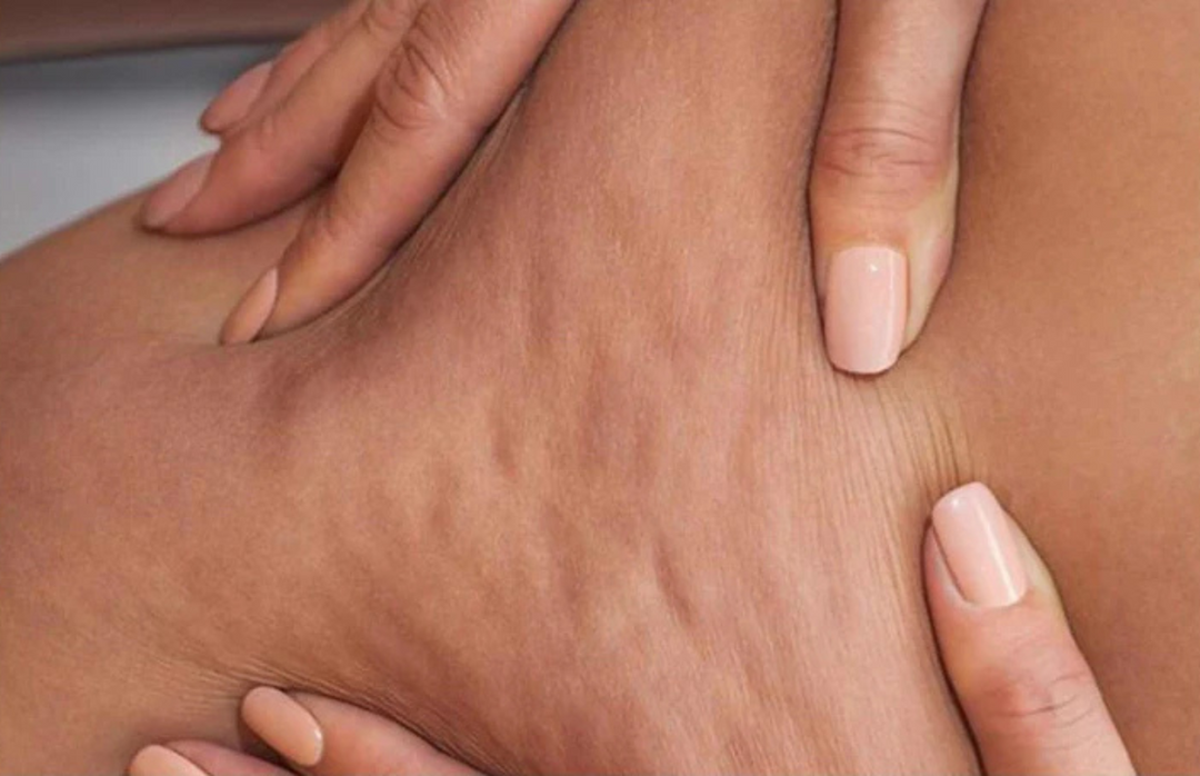 Cellulite Care at Home